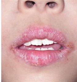 Сухие губы: профилактика и лечение