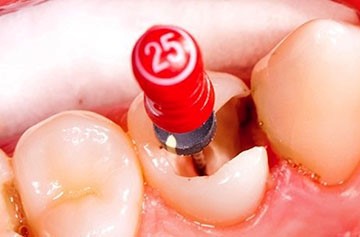 Лечение зубов методики проведения лечебных процедур