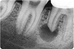 Что такое резорбция (разрушение) зуба?