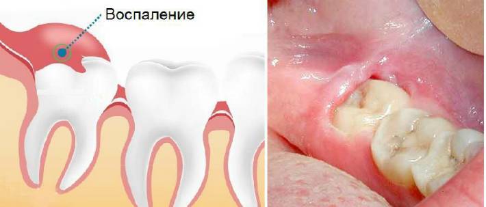 Рекомендации пациенту после удаления зуба … — Стоматологическая клиника в Димитровграде